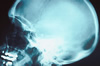 Google Brain Implants?
